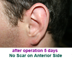 plastic-surgery-prominent-ear 